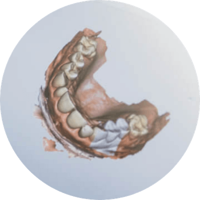 Amprentare digitală realizată cu scanner intraoral
